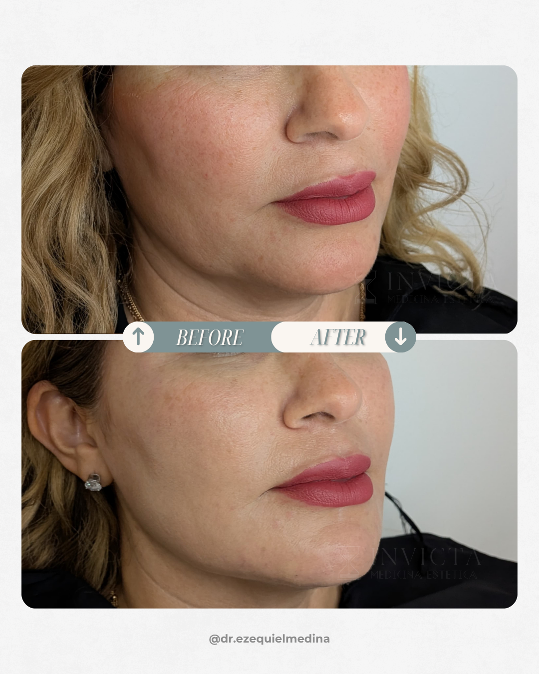 Antes y después — Faciales Médicos
