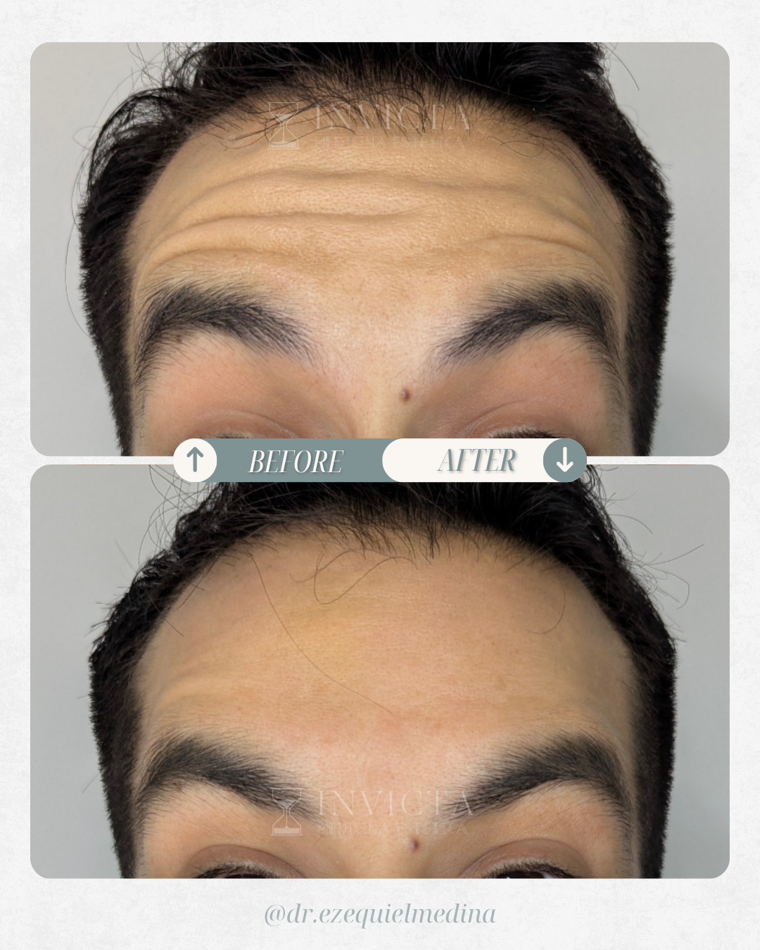 Antes y después — Toxina Botulínica