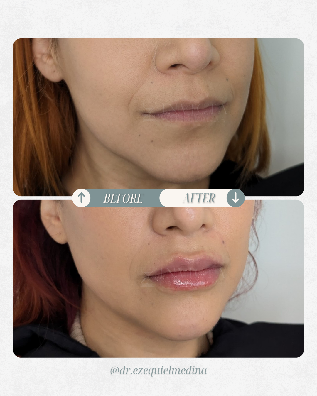 Antes y después — Armonización Facial