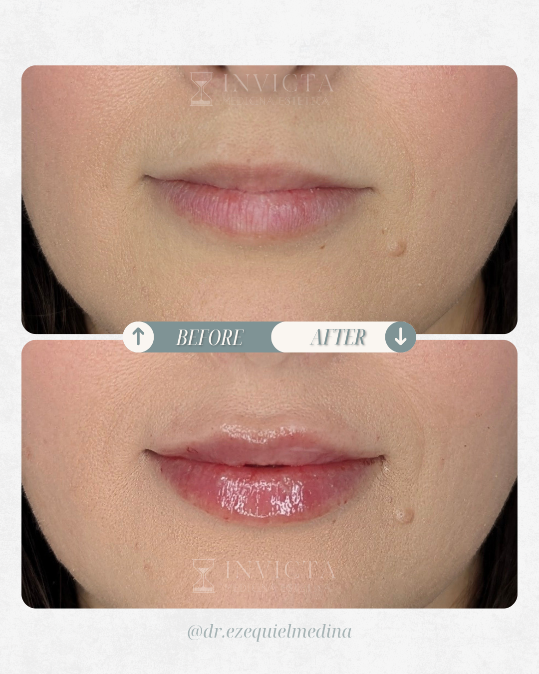 Antes y después — Armonización Facial