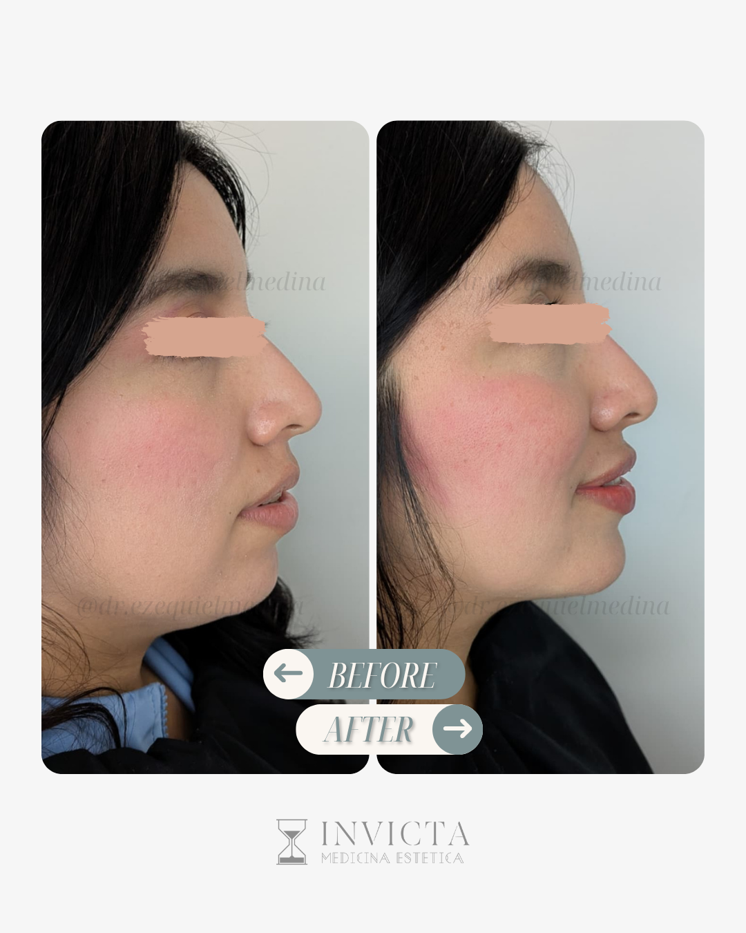 Antes y después — Armonización Facial
