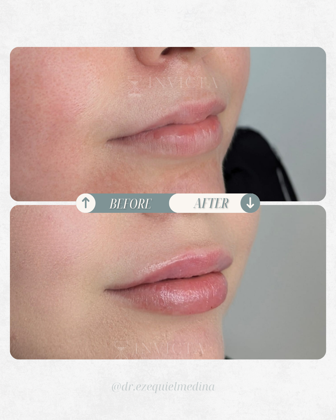 Antes y después — Armonización Facial