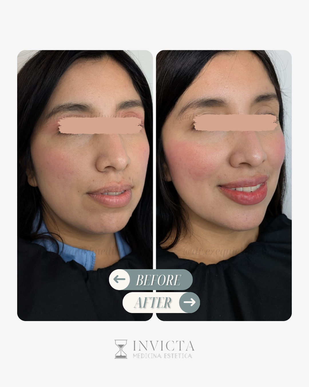 Antes y después — Armonización Facial